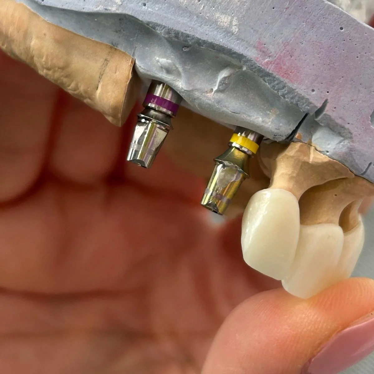 Zubni implantati